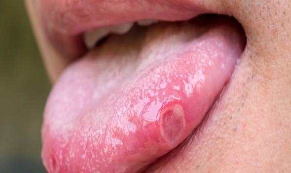 10 طرق لعلاج قرح الفم